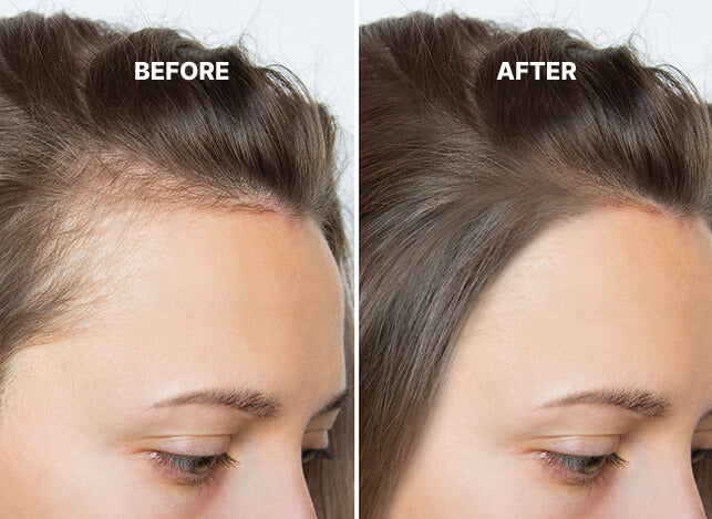 Anti-Hair Loss Therapy